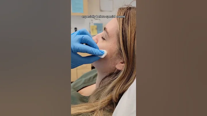 HOW TO: How a Dermatologist gets rid of a painful acne cyst in 48 hours!