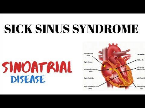 Sick Sinus Syndrome SSS | Sinoatrial disease | medinject - YouTube