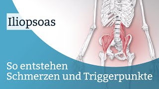 : Iliopsoas Schmerzen, Triggerpunkte und deren Aktivierung