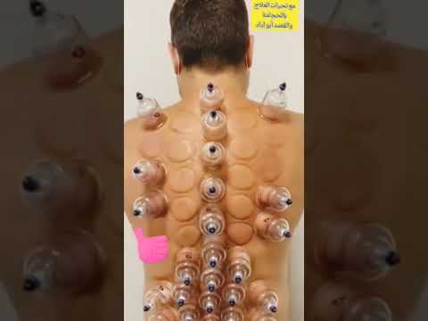 خير ما تداويتم به الحجامة 