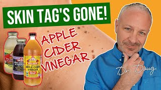 SKIN TAG  * FIX * THAT WORKS!