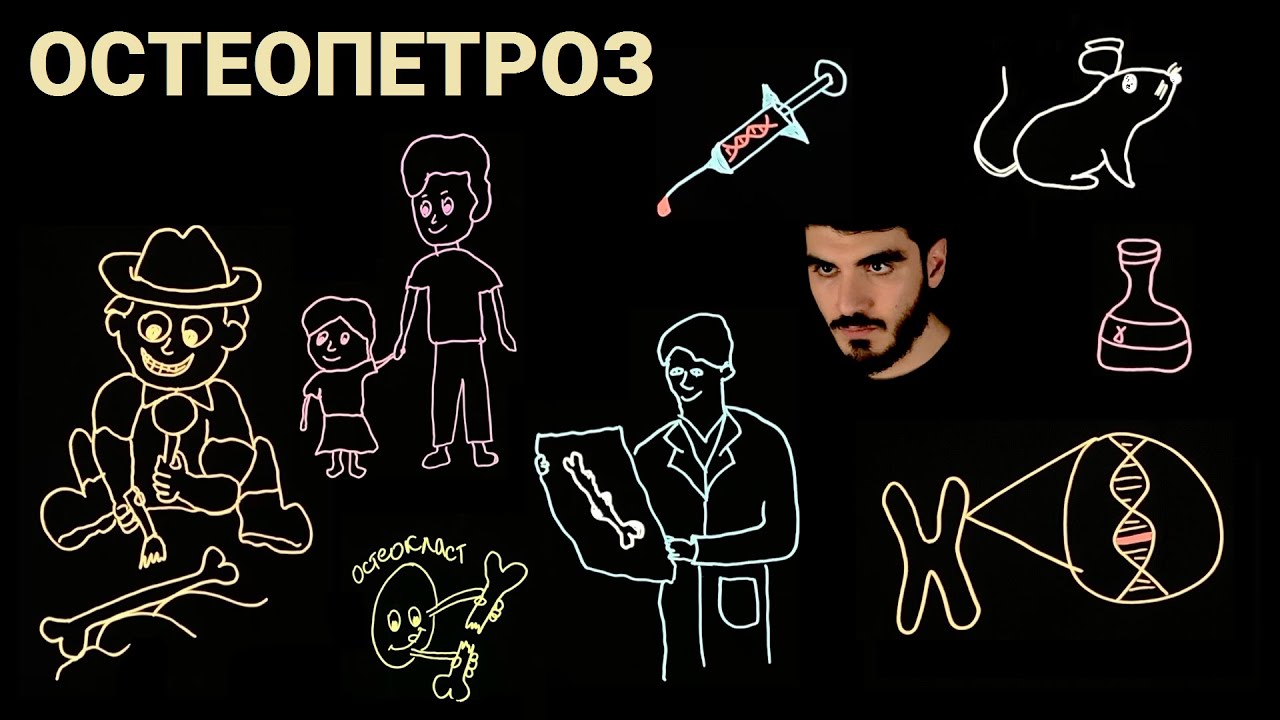 Остеопетроз ►12 месяцев #12