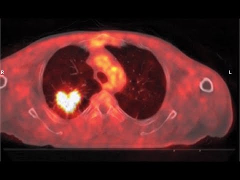 Video: Lungen-PET-Scan: Zweck, Verfahren Und Vorbereitung