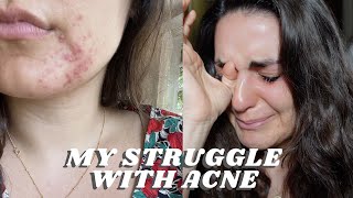 My Struggle with Acne