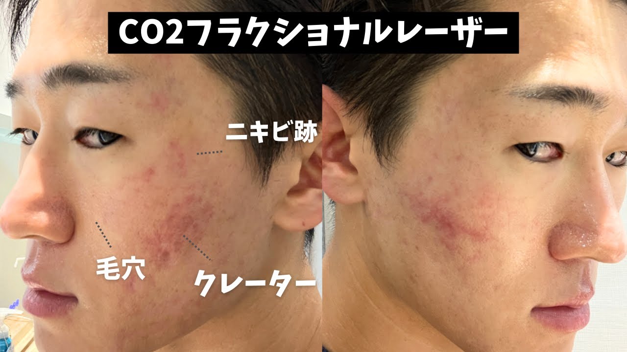 お得すぎる⁈ CO2フラクショナルレーザーでクレーター・毛穴・ニキビ跡は改善したのか？【経過・値段・ダウンタイム・ビフォーアフター】
