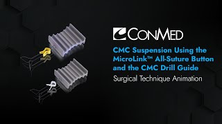 Cmc Suspension Using Microlink And Cmc Drill Guide - Conmed Animation