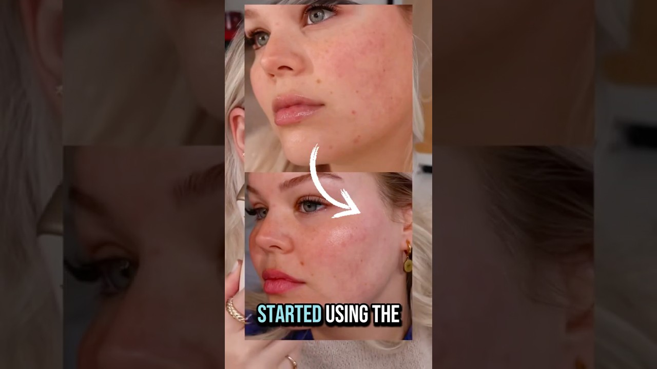Visible Changes with DermRays Revive After Weeks! 