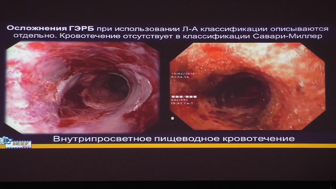 24 Федоров ЕД Эозинофильный эзофагит
