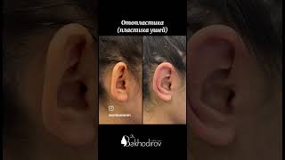 Super Natija🔥🔥 Otoplastika operatsiyasi #nodirbakhodirov #doctor #rek #beauty #operatsiya