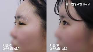 또렷한 눈매 만들어주는 민트실상안검 시술 영상 톡스앤필 천안불당점 아산 피부과, 리프팅