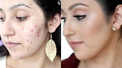 How I Got Rid Of My Acne + Faded My Scars