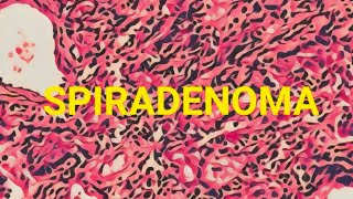 Spiradenoma (Benign adnexal neoplasm - sweat gland)
