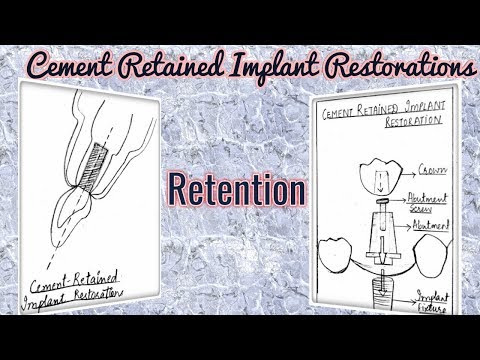 Retention - Cement Retained Implant Restorations