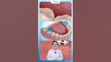 Niềng Răng Hô, Khớp Cắn Sâu | Nha Khoa Minh Châu