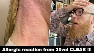 She is BURNING her skin with 30vol CLEAR developer !!! Hairdresser reacts to hair fails