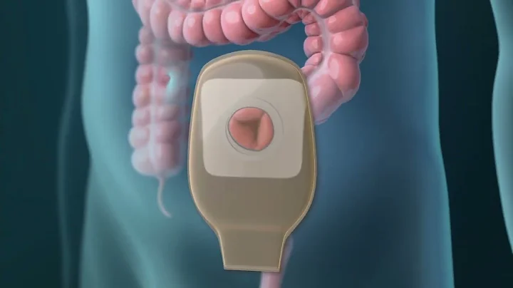 Colorectal Cancer: Treatment Options