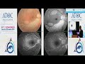 Mystery retina 1  dr selim ben yahya  atoc 2019  jour 1