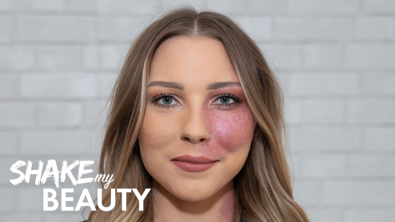 Modelling Helped Me Beat My Birthmark Bullies | SHAKE MY BEAUTY