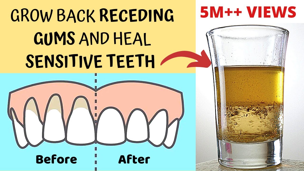 Heal Receding Gums And Grow Back | Treat Sensitive Teeth And Reverse Receding Gums | Gingivitis