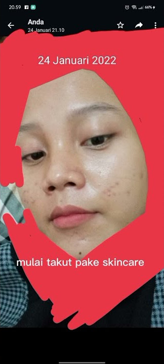 Pejuang acne yuk glow up bareng rk glow! #carasembuhinjerawat ig:rkglowofficial_new wa:085159911367