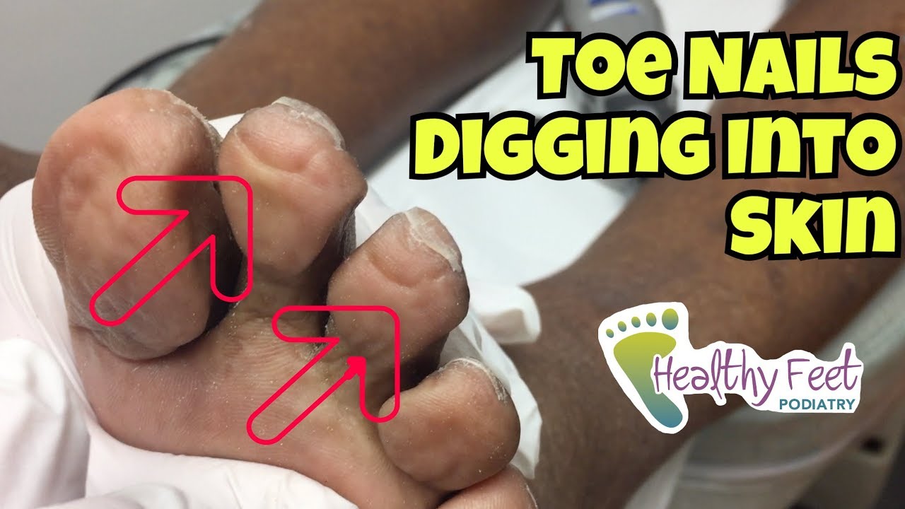 Nails Curling Into Toes - Nail Trimming for Diabetic. Ingrown Nails at the  Ends of the Toe. - YouTube
