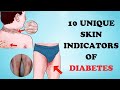 Diabetes alert 10 unusual skin signs you shouldnt ignore  healthy care