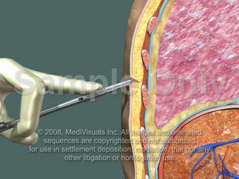 Video: Thoracotomy ua li cas?