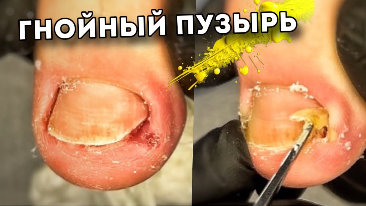 Гнойный экссудат при вросшем ногте #подологтатьянапак #ingrown_toenail ...