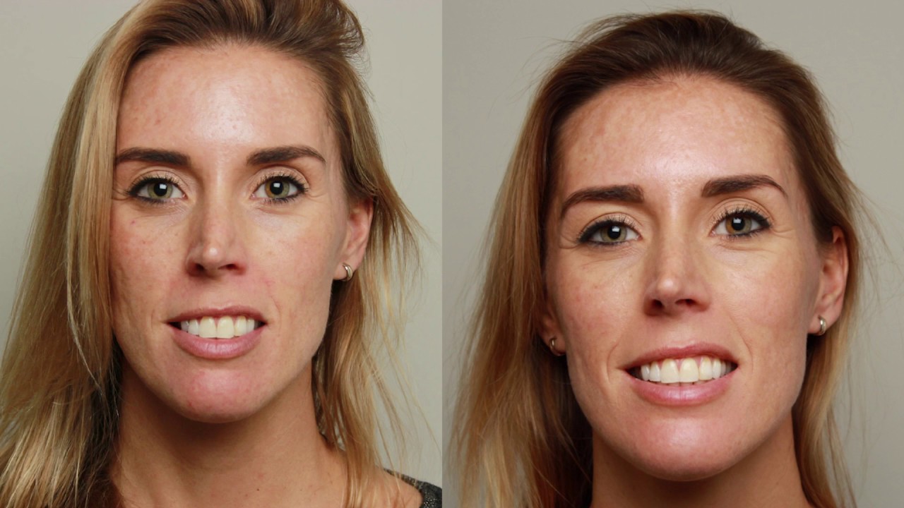 Acnelittekens opvullen met fillers | FURROW.NL