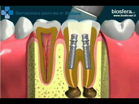 endodontic therapy