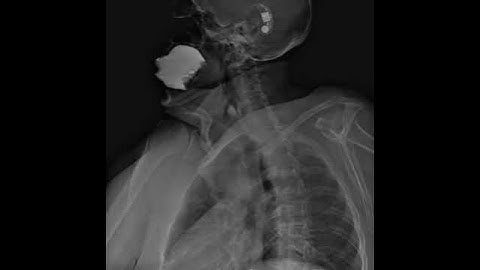 Digital Radiology Retrospective View of Esophagus: Esophagogastroduodenoscopy (SEGD Test) part 1