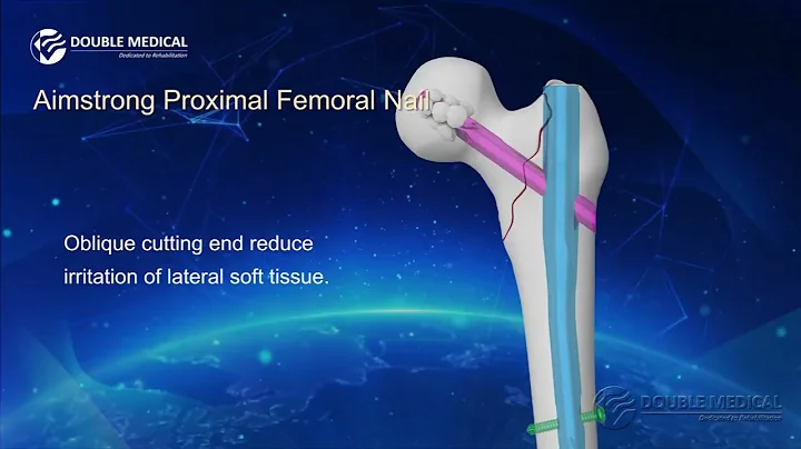 Double Medical Aimstrong Proximal Femoral Nail  APFN