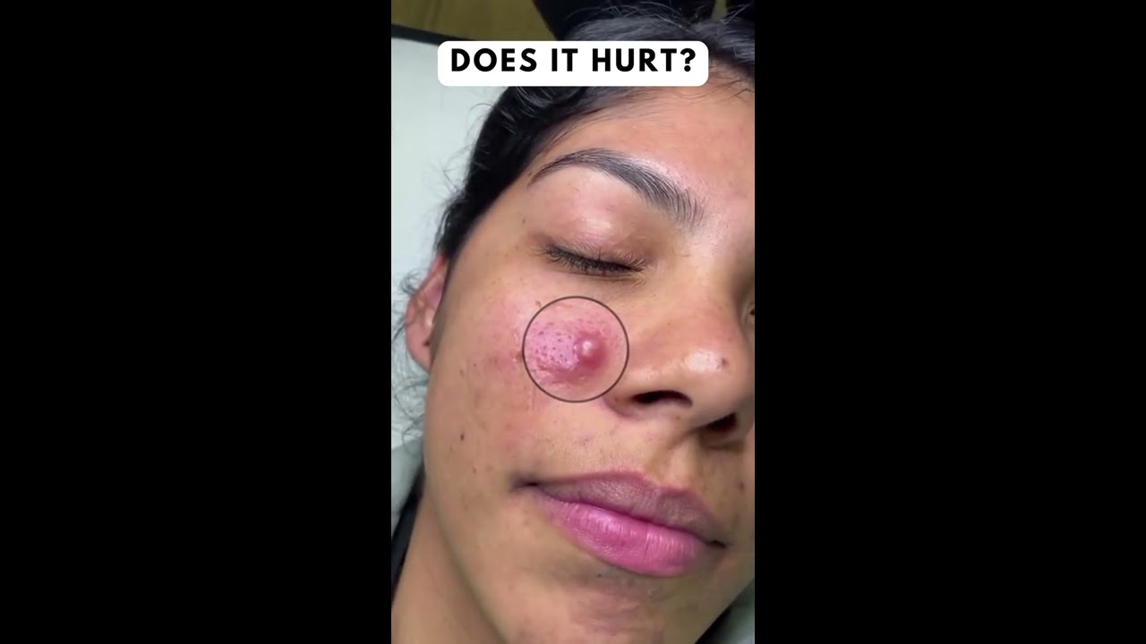 Never Squeeze Acne With Your Hands 