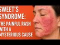 "Sweet’s Syndrome: The Painful Rash with a Mysterious Cause"