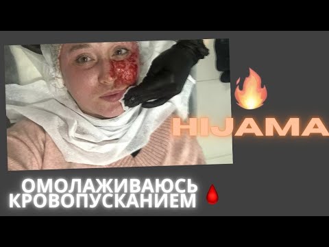 Омолаживание кровопусканием/Исламский метод лечения/Хиджама