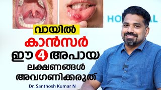 വായിൽ കാൻസർ ഈ 4 രോഗ ലക്ഷണങ്ങൾ അവഗണിക്കരുത് | Oral Cancer | Dr. Santhosh Kumar