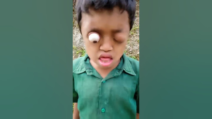 Cậu bé mắt lồi