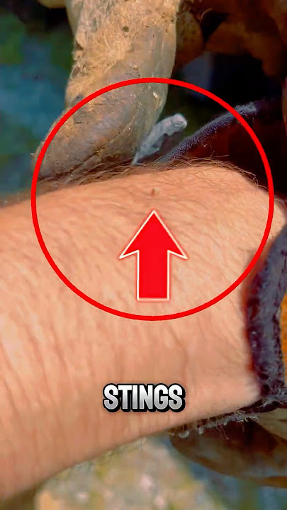 What To Do If a Bee Stings You ❓😱