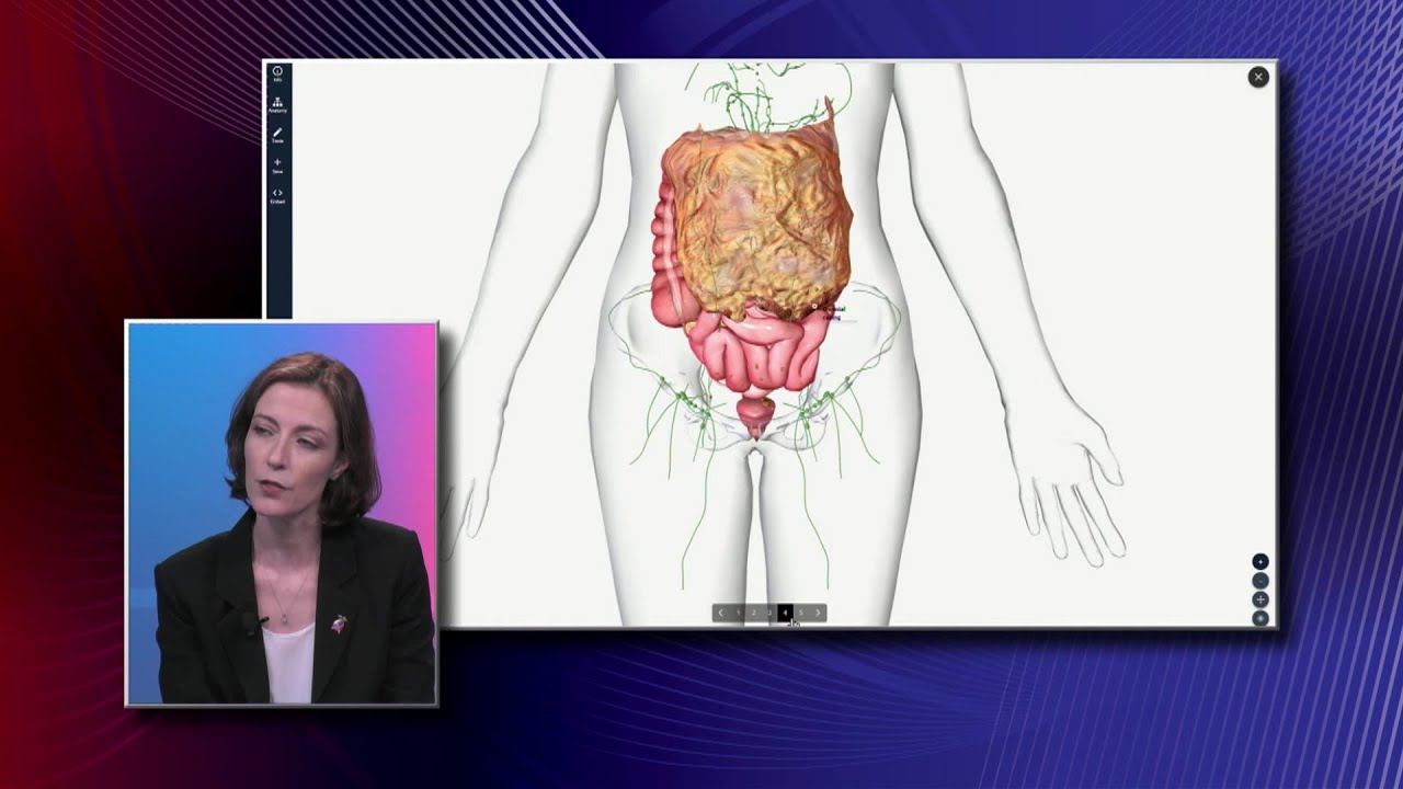 Stages of Ovarian Cancer