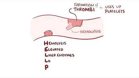 Preeclampsia & eclampsia - causes, symptoms, diagnosis, treatment, pathology
