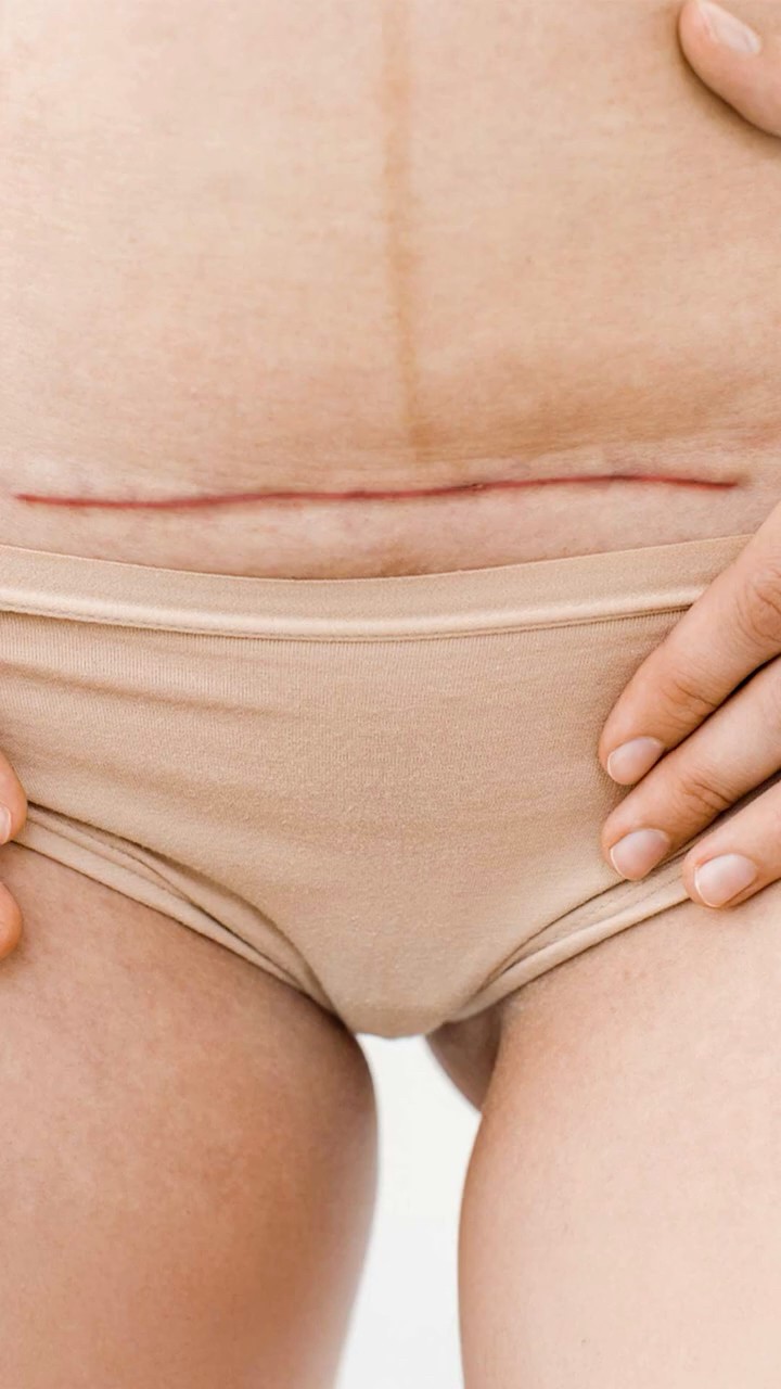 3 cosas sobre la cesárea que todo hombre debe saber @PaoCastilloOf