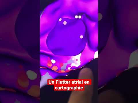 Un Flutter Atrial En Cartographie