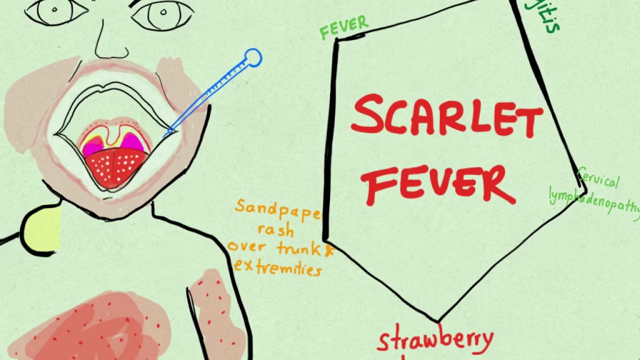 Scarlet Fever - Pediatrics - Medbullets Step 2/3