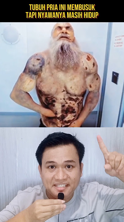 THIS MAN'S BODY IS DECOMPOSITING BUT HIS LIFE IS STILL ALIVE‼️#shorts #storyline #storytelling