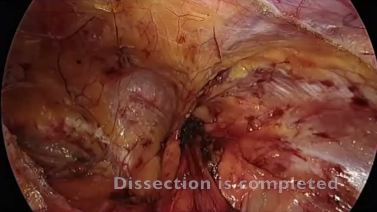 TAPP Repair - Self-Fixating Inguinal Mesh