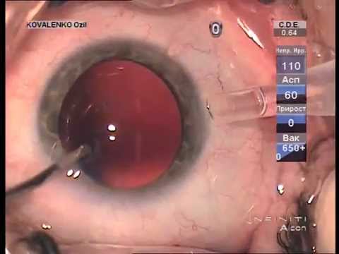 Endocapsular carousel technique phacoemulsification