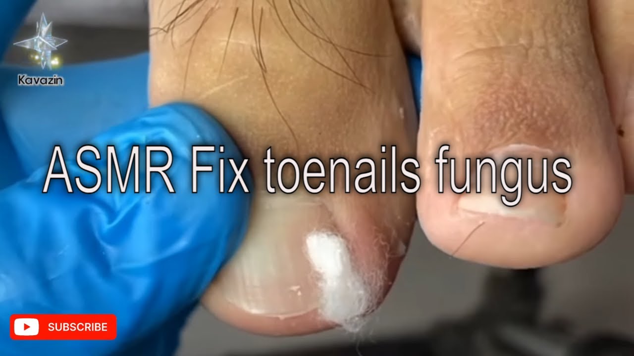 ASMR Fix toenails fungus #ASMR #ToenailFungus #NailCare - YouTube