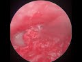 S02E21 - EarWax Cleaning The Bad Inflammation Ear Canal &amp; Light Reddish Wax Cleaning On Drum