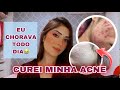 COMO CUREI MINHA ACNE SEM ROACUTAN