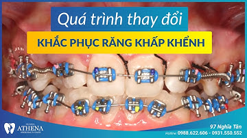 Niềng răng mắc cài kim loại - khắc phục răng khấp khểnh | Nha khoa quốc tế Athena